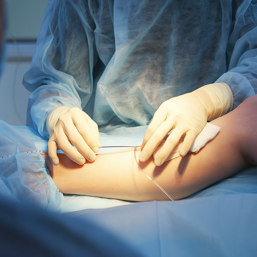 Минифлебэктомия вен