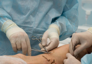 Минифлебэктомия вен нижних конечностей