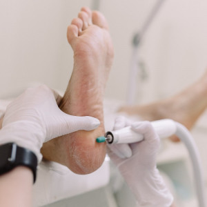 Аппаратный педикюр стержневой мозоли