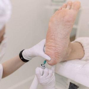 Удаление подошвенных бородавок