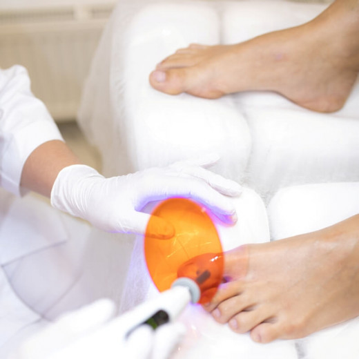 Удаление варикоза лазером