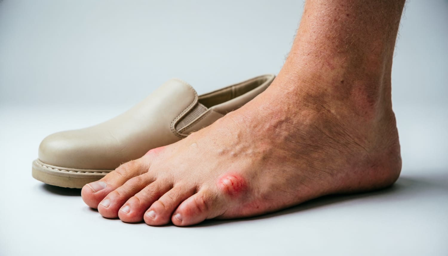 Артроз и ригидный большой палец (hallux rigidus)